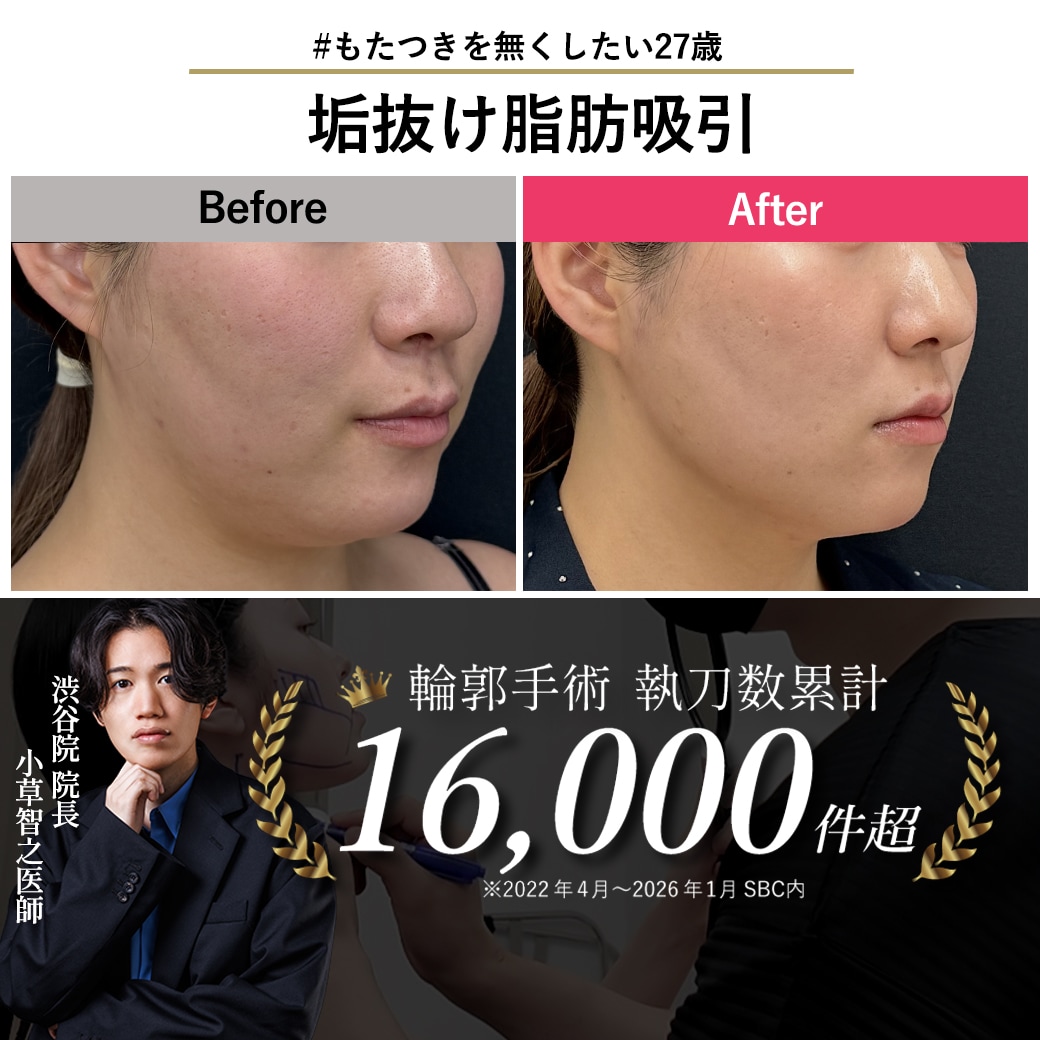 【顔の脂肪吸引の名医】脂肪吸引でアラサーのもたつき解消【脂肪吸引が上手いおぐさ先生】