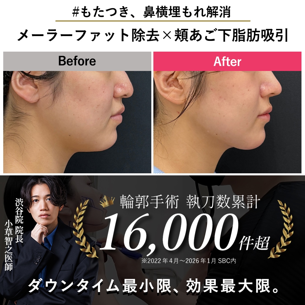 【顔の脂肪吸引の名医】メーラーファット除去で鼻埋もれ解消【脂肪吸引が上手いおぐさ先生】