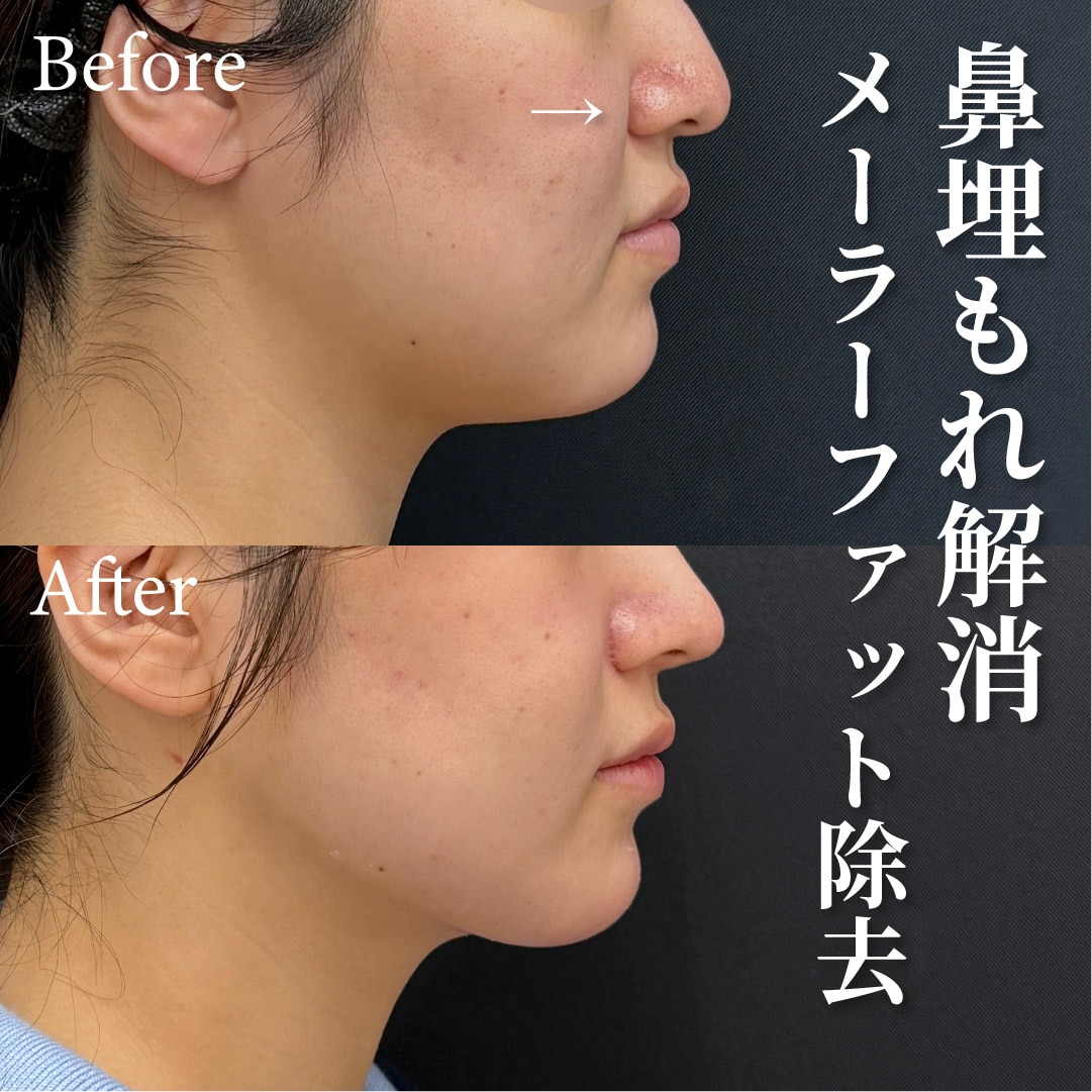23歳女性のモニター様