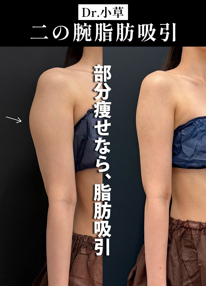 【二の腕脂肪吸引の名医】気になるところをピンポイントで細く【二の腕脂肪吸引が上手いおぐさ先生】