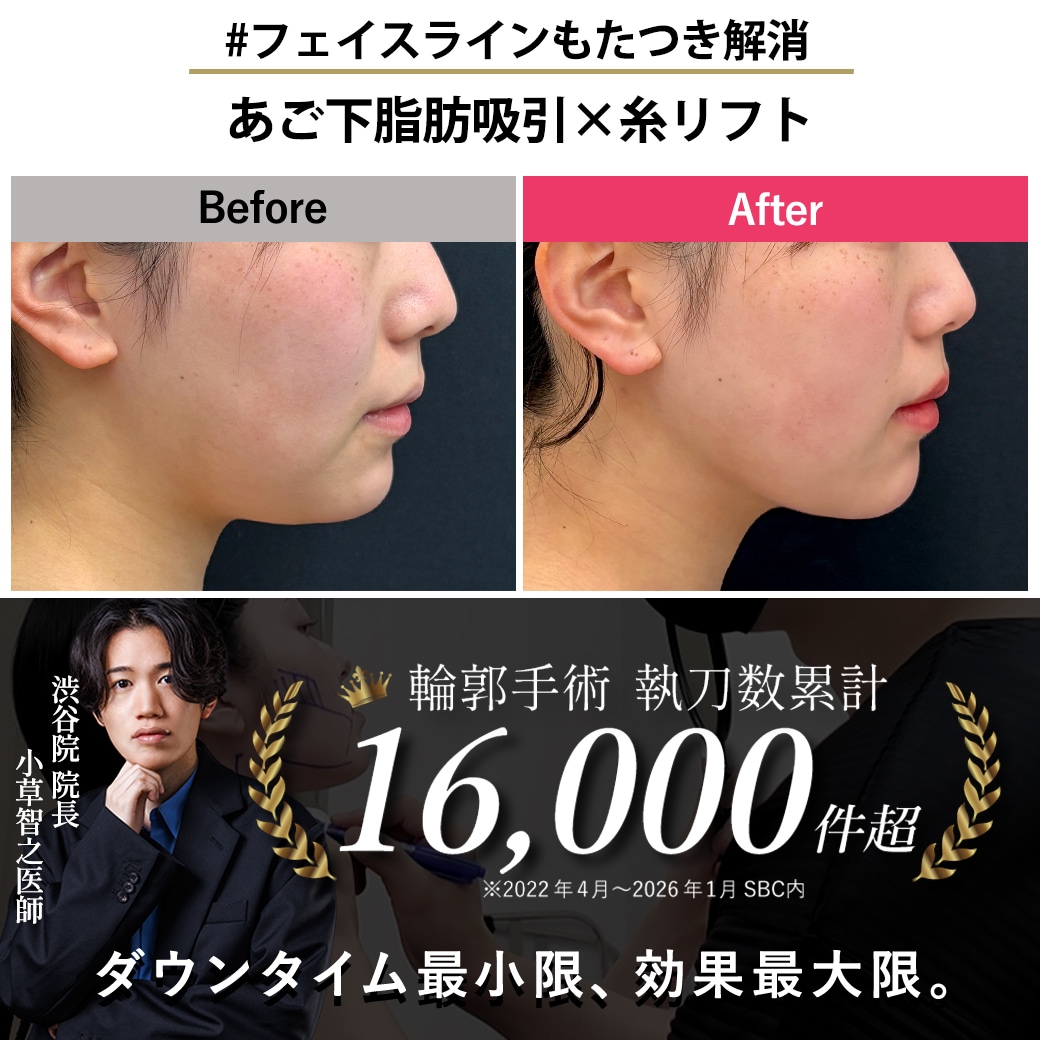 【顔の脂肪吸引の名医】あご下脂肪吸引でフェイスラインくっきり【脂肪吸引が上手いおぐさ先生】