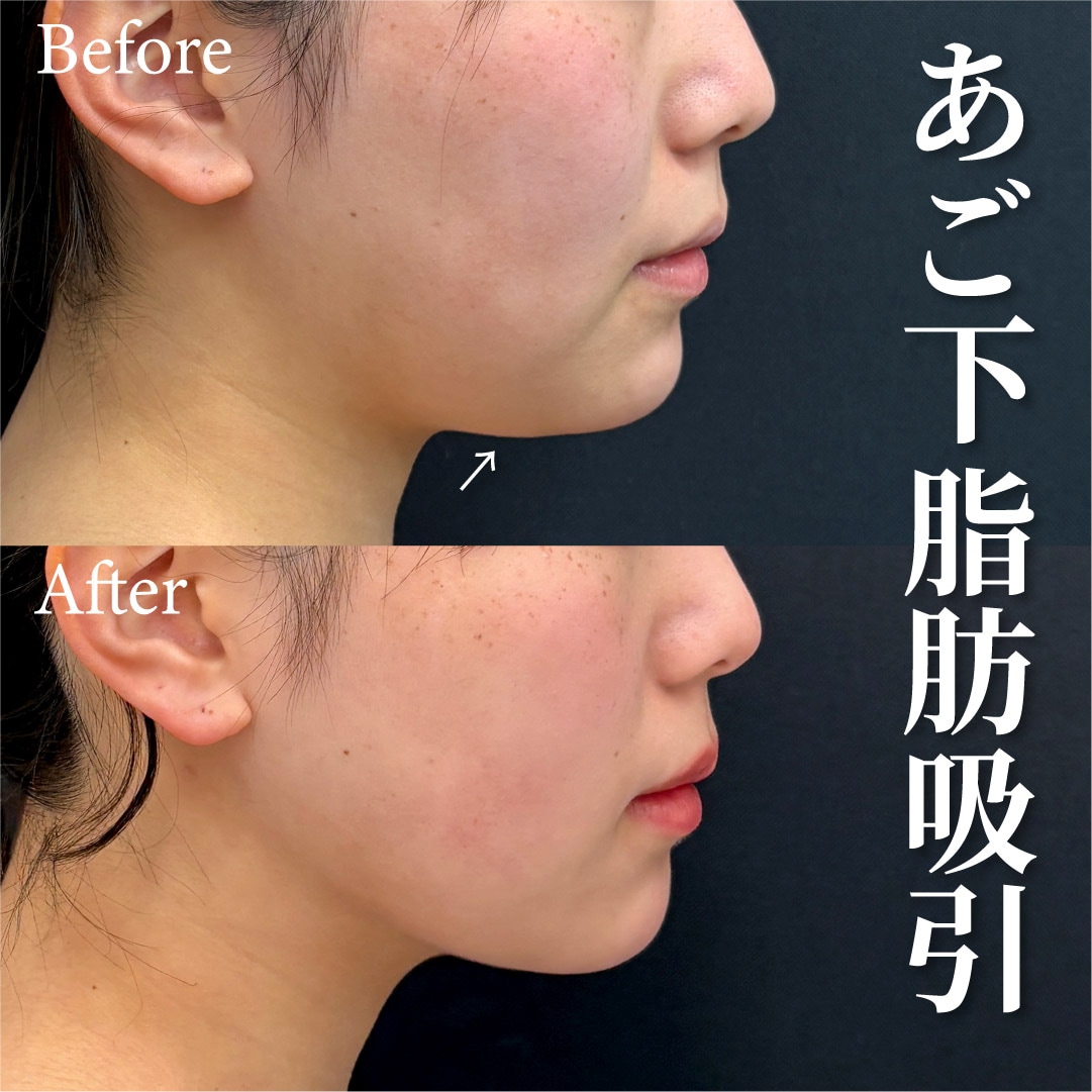 20歳女性のモニター様