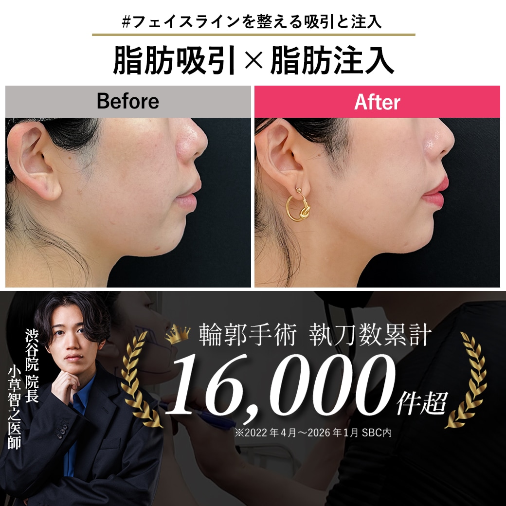 【顔脂肪吸引の名医】20代のコンプレックス解消!髪で隠す日々を卒業できた!