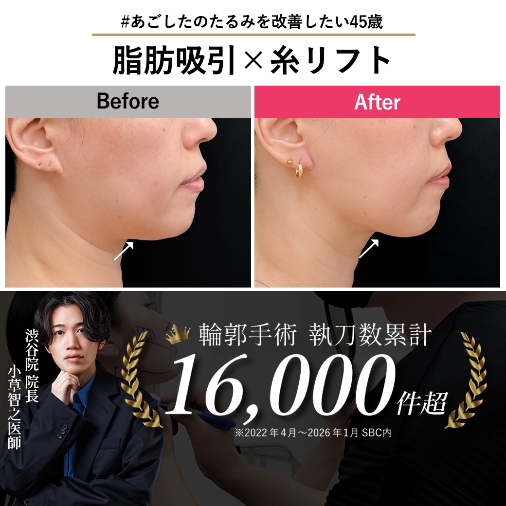 【顔脂肪吸引の名医】40代のたるみ・もたつきを撃退!引き締め×リフトアップで叶える若返り小顔術