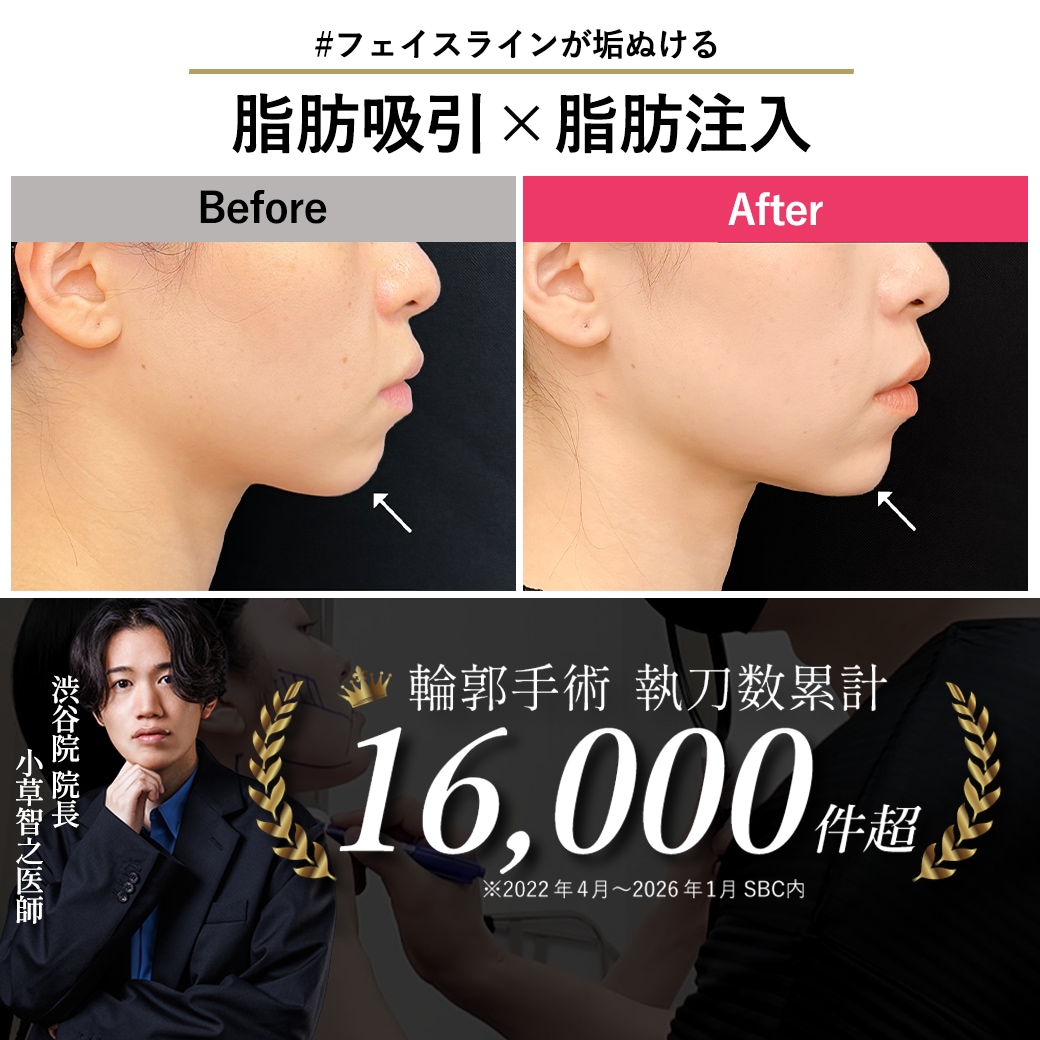【顔脂肪吸引の名医】遠方からのご来院!脂肪注入と合わせることで理想のVラインへ
