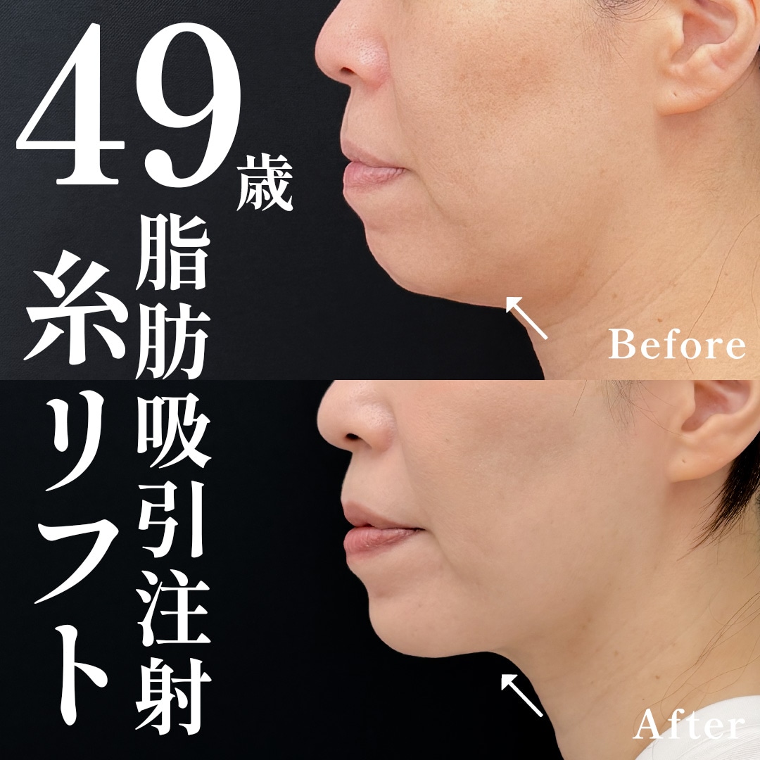 49歳女性のモニター様