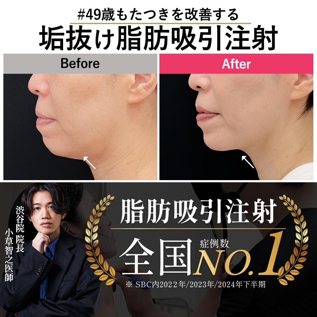 【脂肪吸引注射の名医】40代のたるみを撃退!「痩せた?」と褒められる若返り小顔術