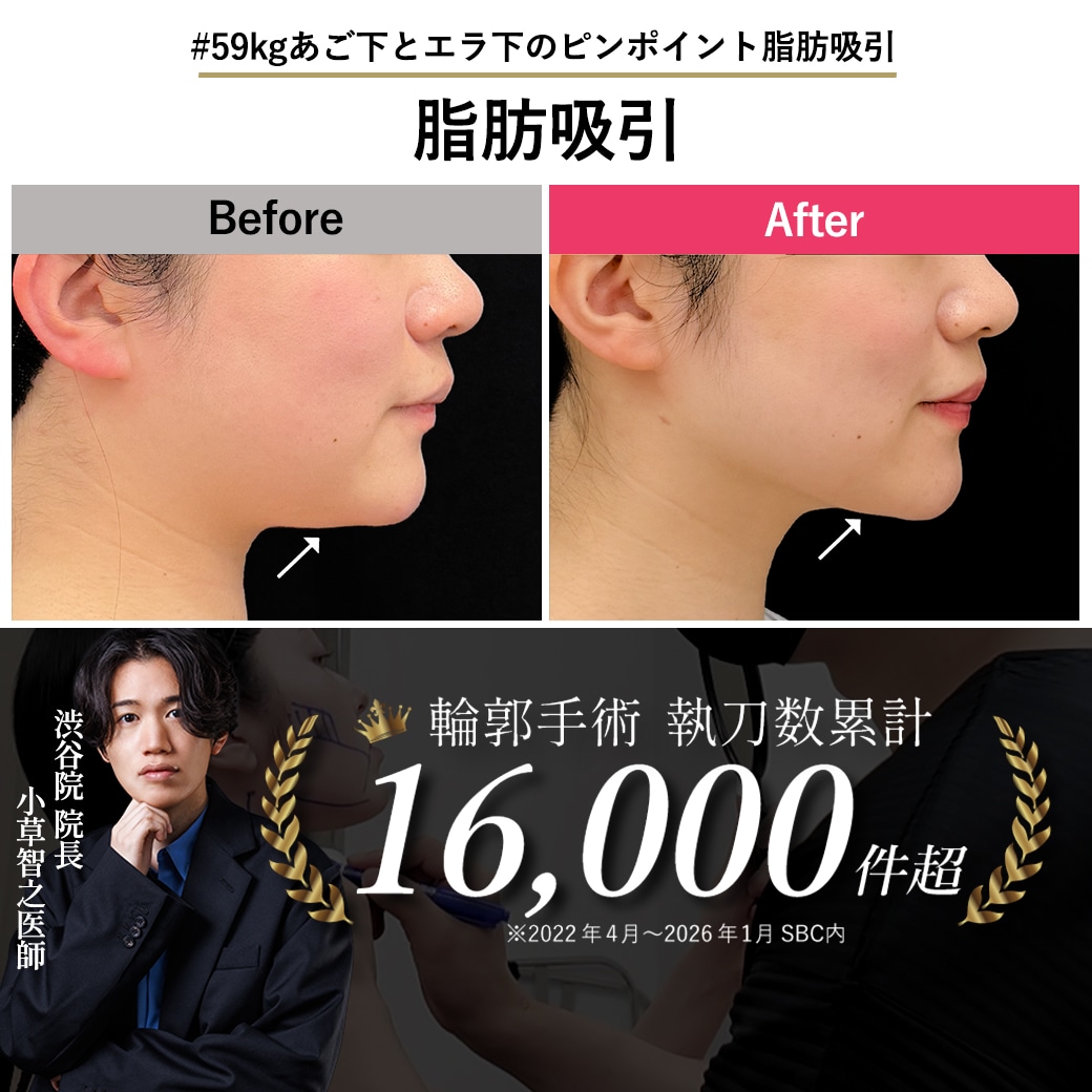 【顔脂肪吸引の名医】59kg初めての整形でコンプレックス解消!「自分を好きになれる」あご下すっきり術