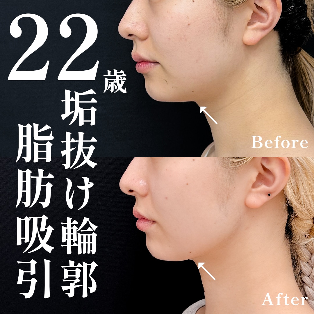 22歳女性のモニター様
