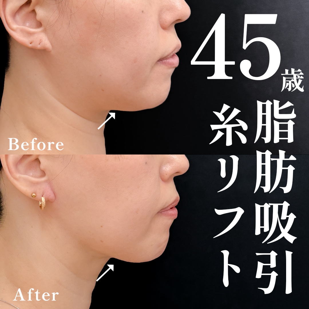 40代女性のモニター様