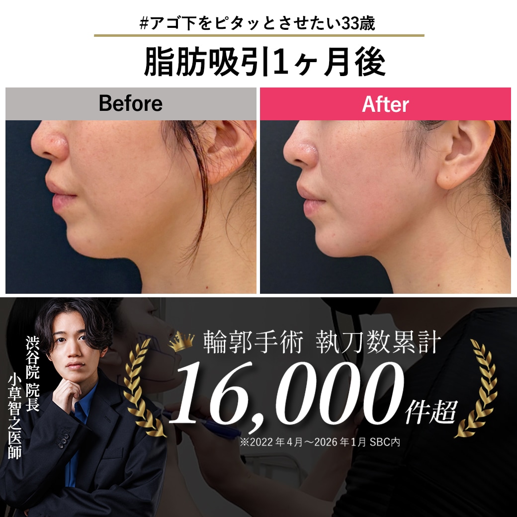 【顔の脂肪吸引の名医】アゴ下脂肪吸引単体の症例紹介【脂肪吸引が上手いおぐさ先生】