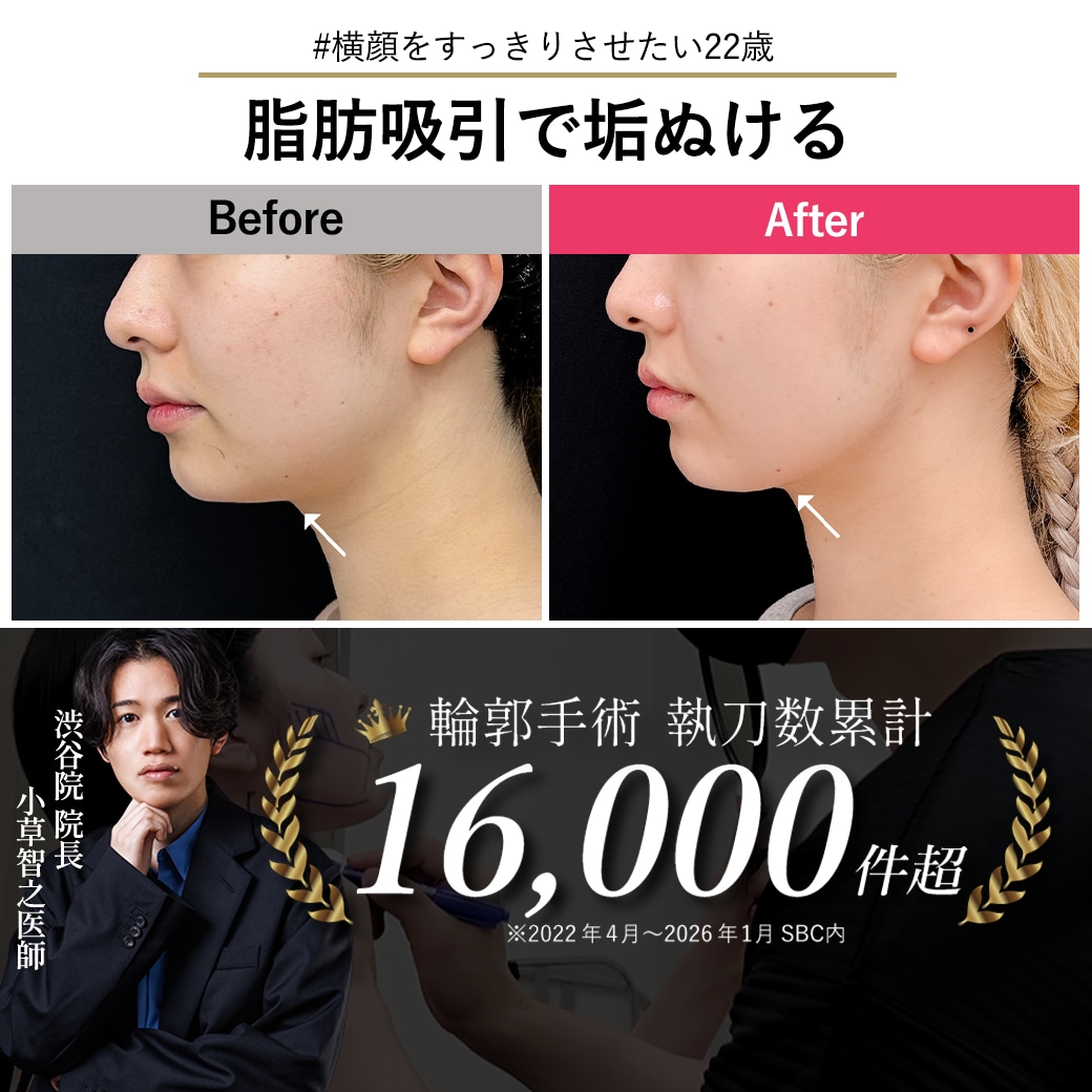 【顔脂肪吸引の名医】22歳で叶える圧倒的垢抜け！「痩せた？」と聞かれる横顔＆顎下スッキリ術