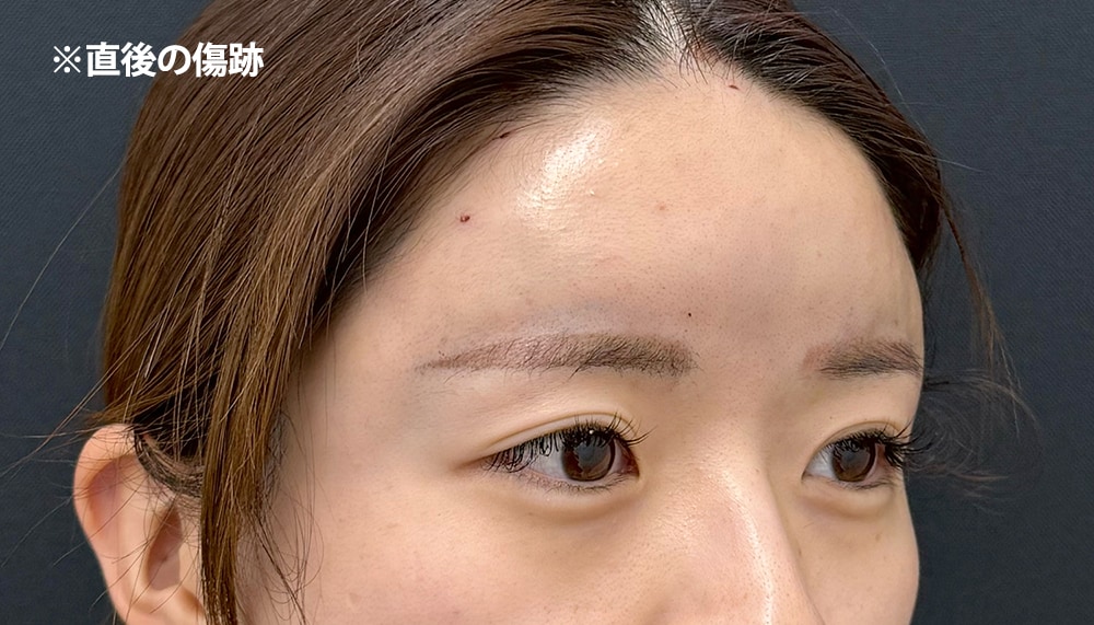 脂肪注入