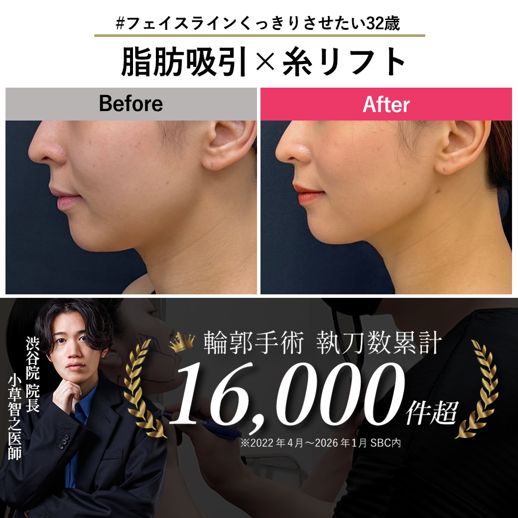【顔の脂肪吸引の名医】アゴ下脂肪吸引×糸リフトでアラサーのもたつき解消【脂肪吸引が上手いおぐさ先生】