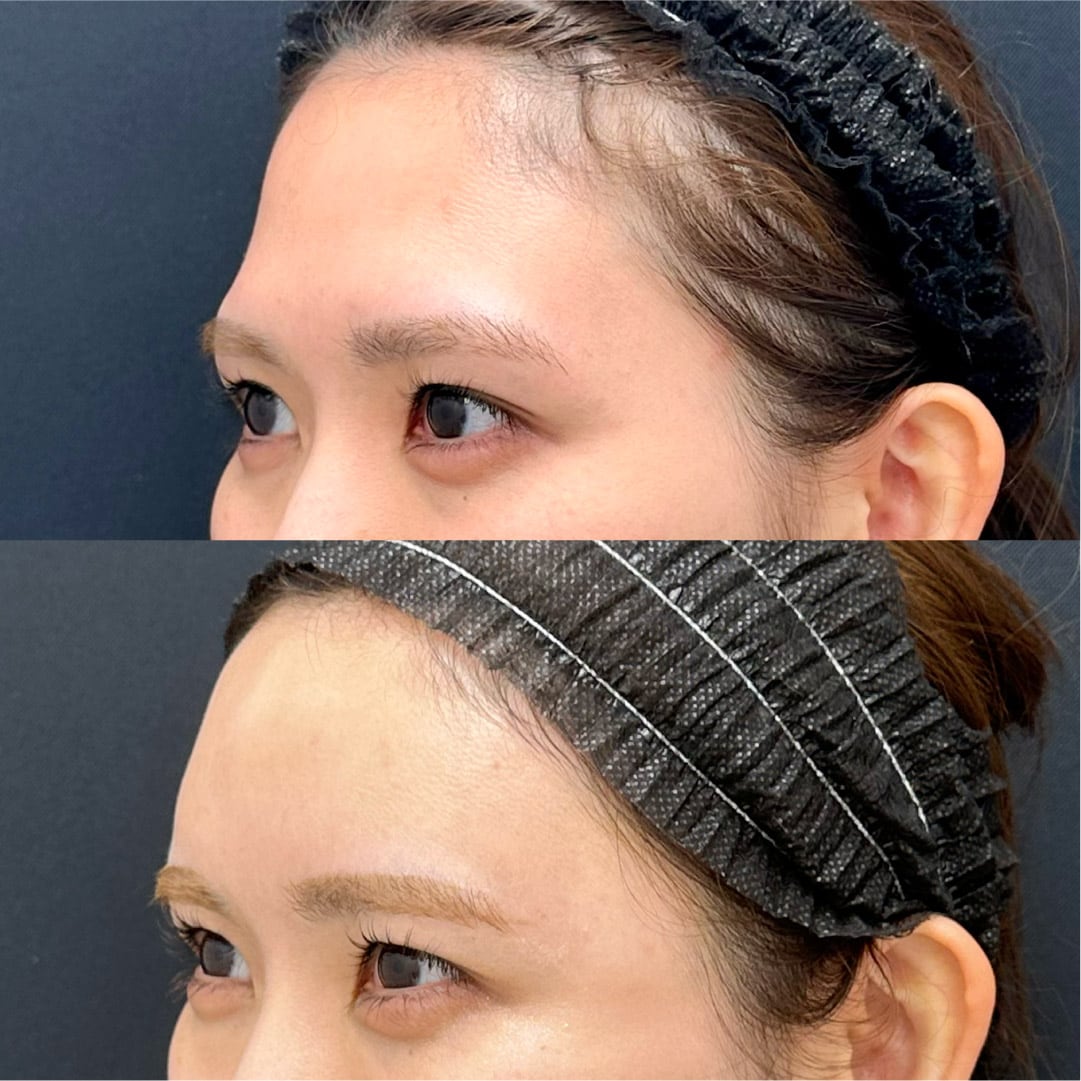 【丸く立体的なおでこへ】輪郭形成の名医が解説する「額の脂肪移植」完全ガイド
