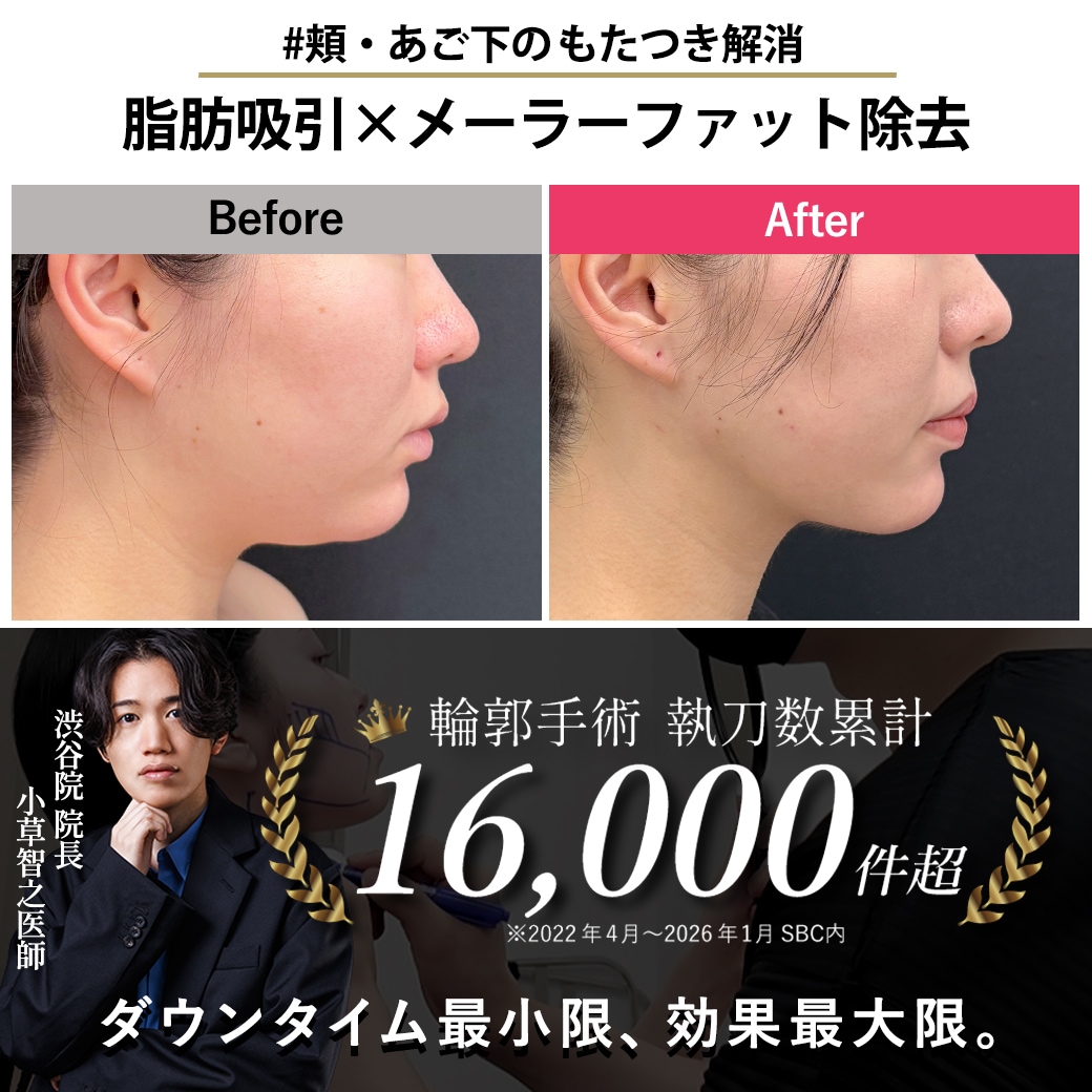 【顔の脂肪吸引の名医】鼻横・あご下のもたつき解消【脂肪吸引が上手いおぐさ先生】