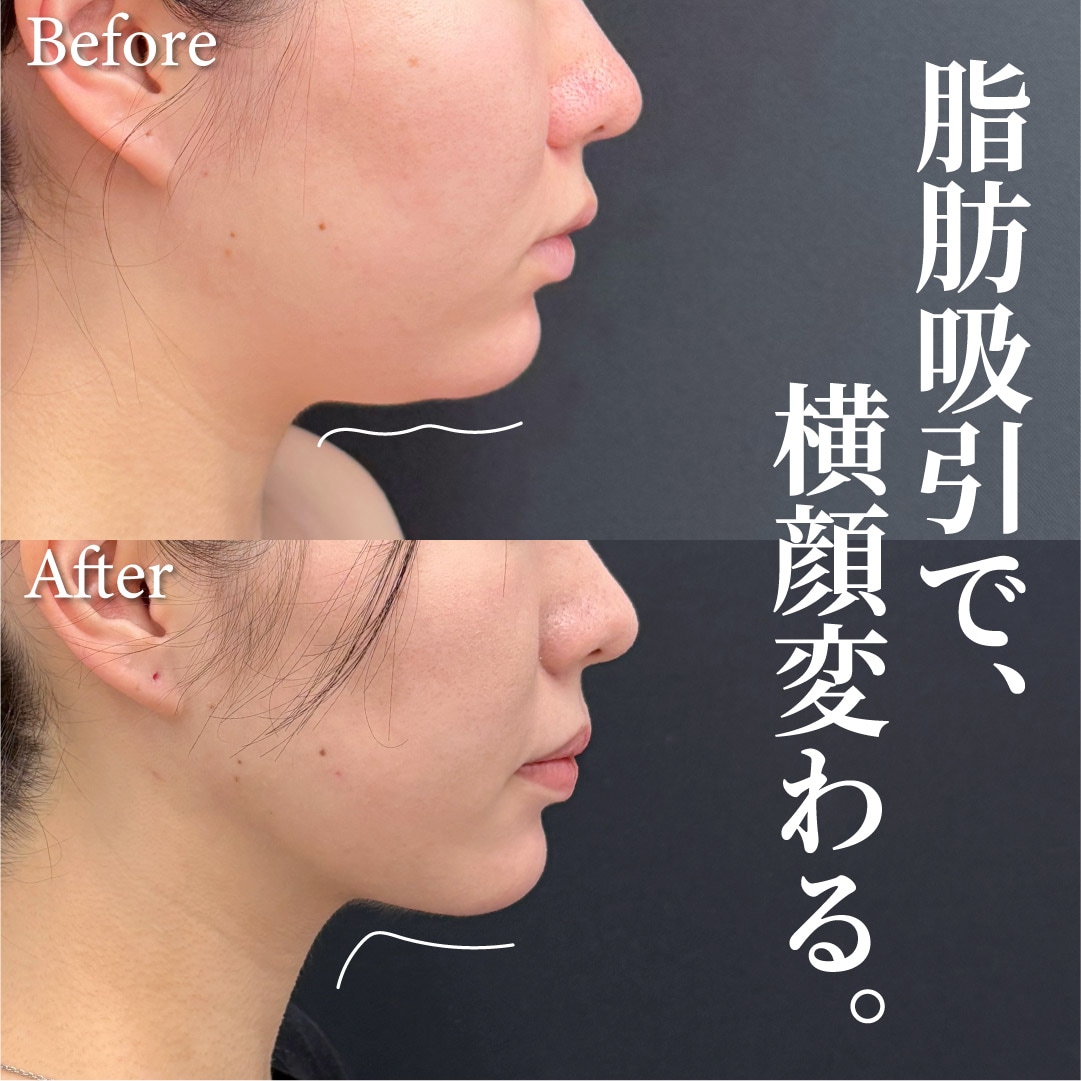 22歳女性のモニター様