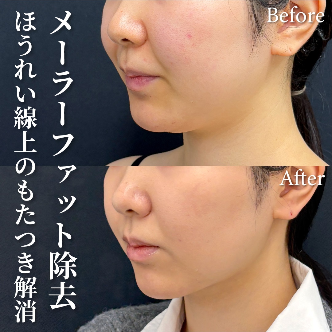 20代女性のモニター様