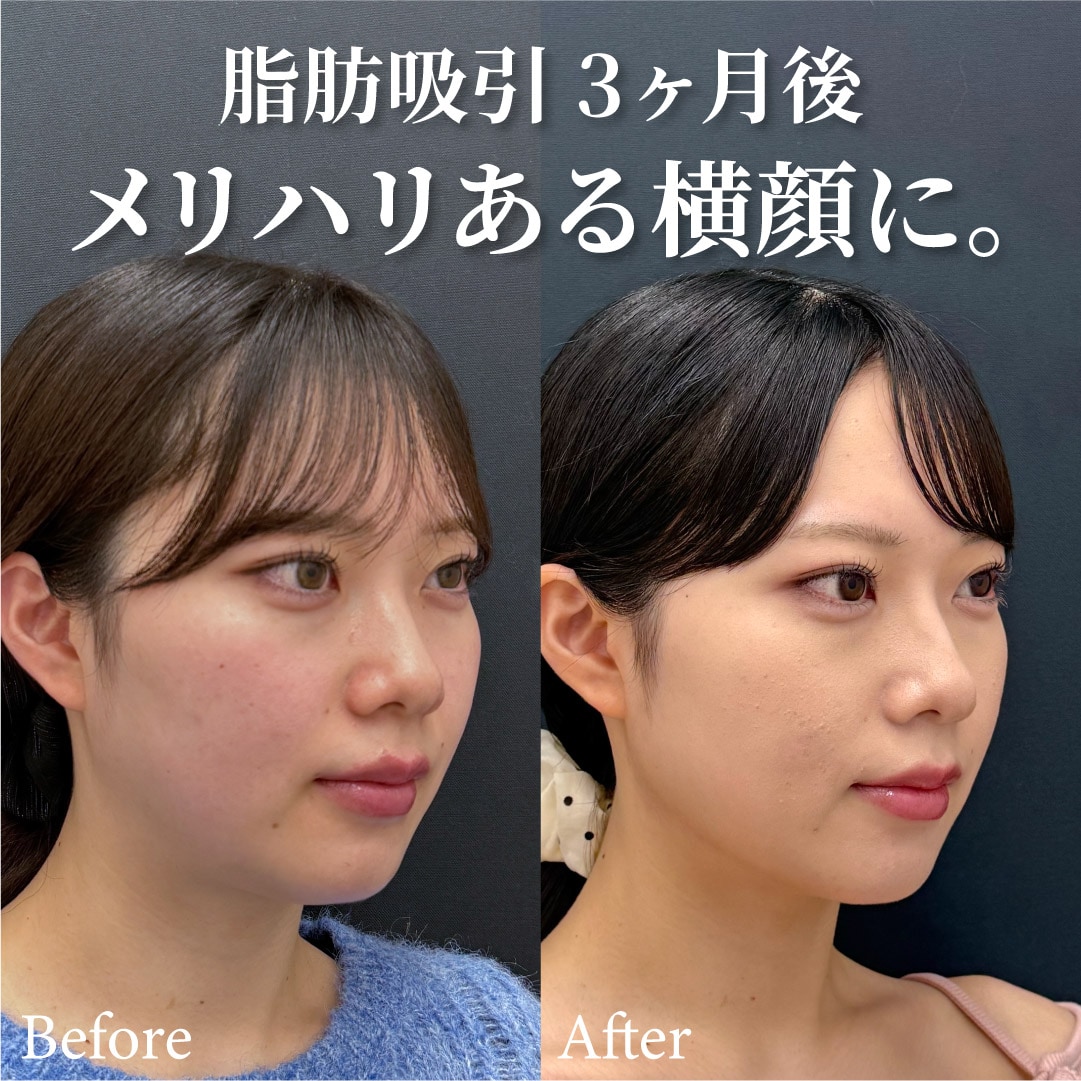 23歳女性のモニター様