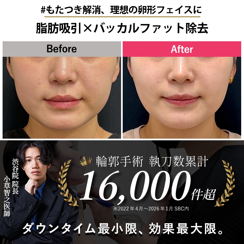 【顔の脂肪吸引の名医】頬のもたつき解消して、理想の卵形に【脂肪吸引が上手いおぐさ先生】