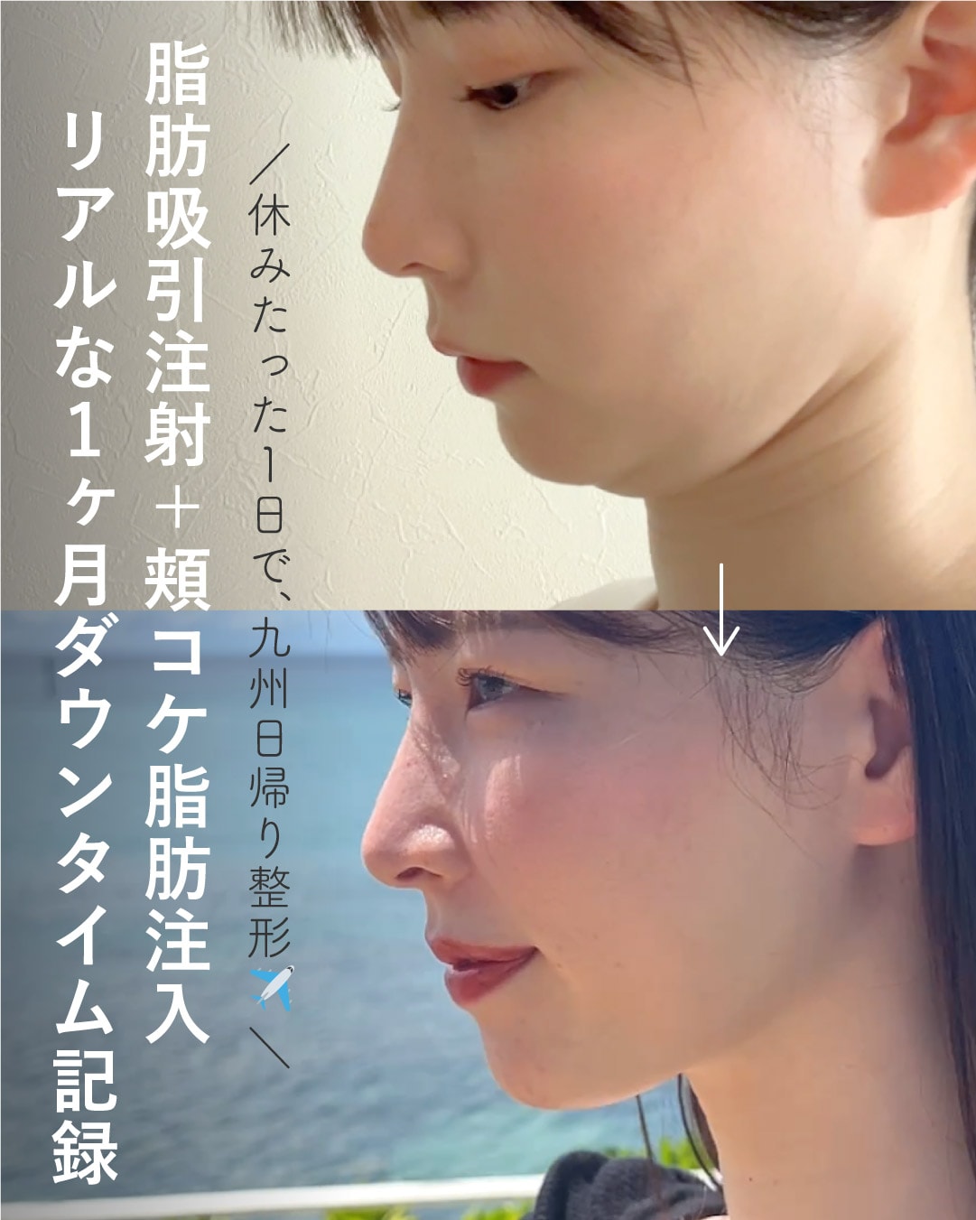 【脂肪吸引注射】福岡から渋谷まで、アラサー女子の日帰り整形旅。術後１ヶ月でフェイスライン激変