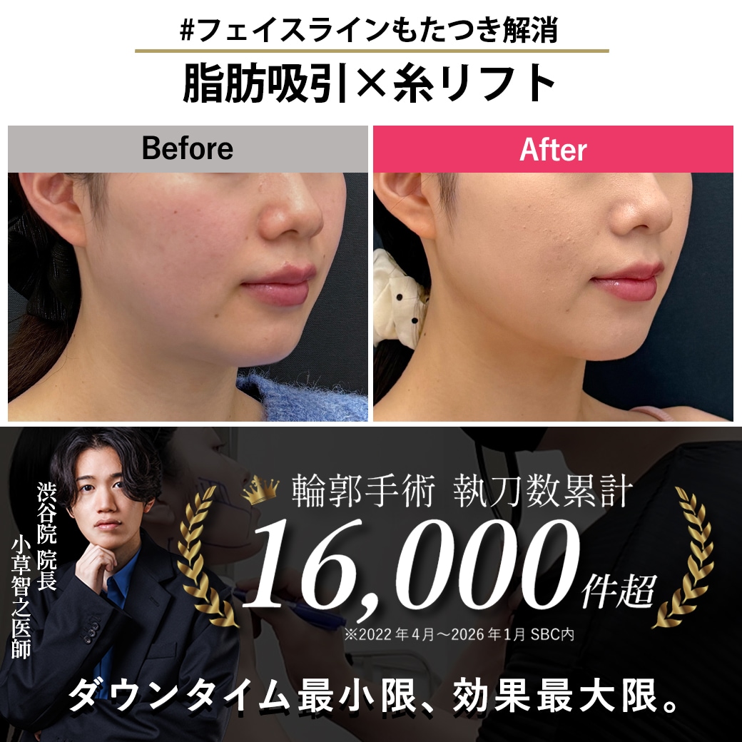 【顔の脂肪吸引の名医】フェイスラインぼやけ解消【脂肪吸引が上手いおぐさ先生】