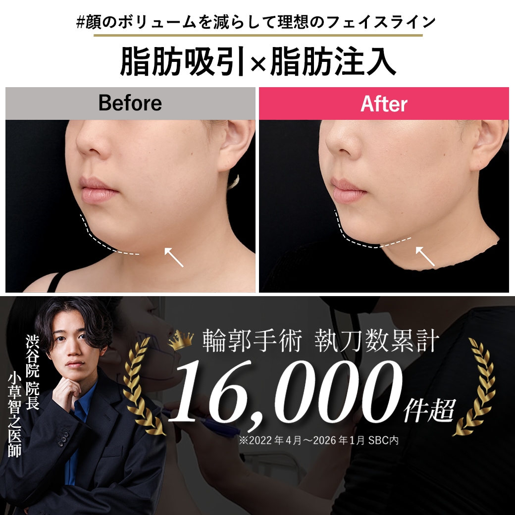 【顔脂肪吸引の名医】横顔コンプレックス解消!翌日もバレない垢抜け小顔術