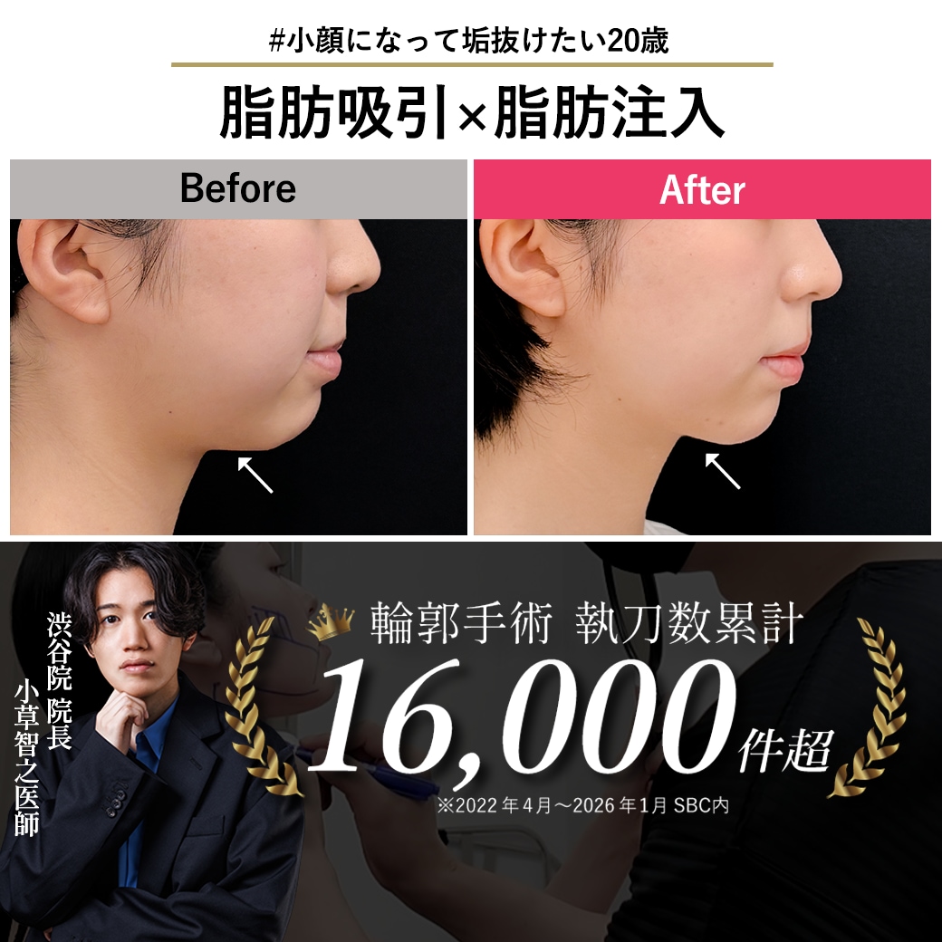 【顔脂肪吸引の名医】悩んでいた輪郭から解放！人生が明るくなる理想の小顔デザイン