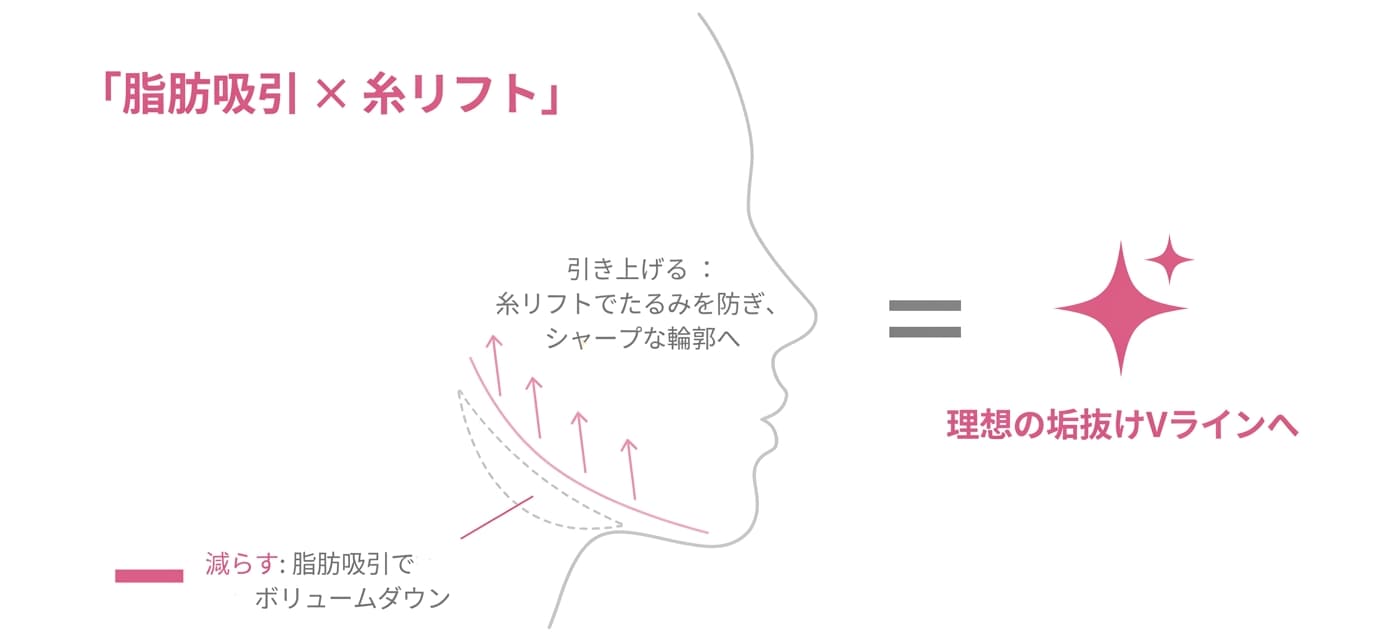 相乗効果で圧倒的Vライン！セットでおすすめする理由