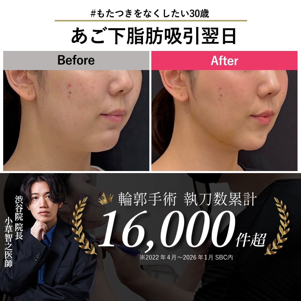 【顔の脂肪吸引の名医】顎下脂肪吸引の翌日【脂肪吸引が上手いおぐさ先生】