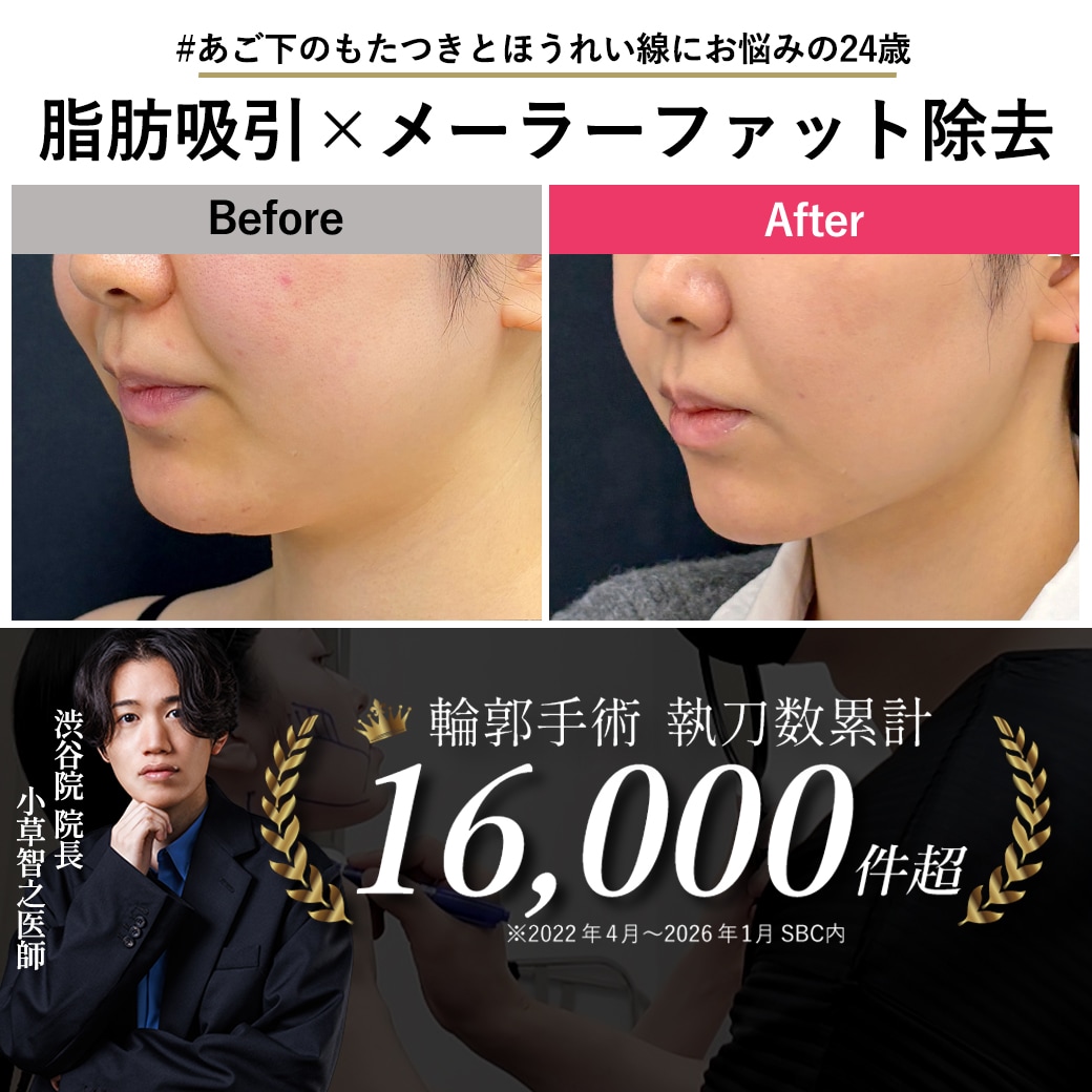 【ほうれい線解消】脂肪吸引×メーラーファット除去で加工いらずの輪郭へ