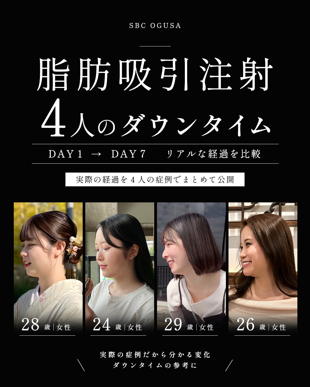 【画像付】４人の顔の脂肪吸引注射のダウンタイム経過！腫れや内出血は？名医の症例