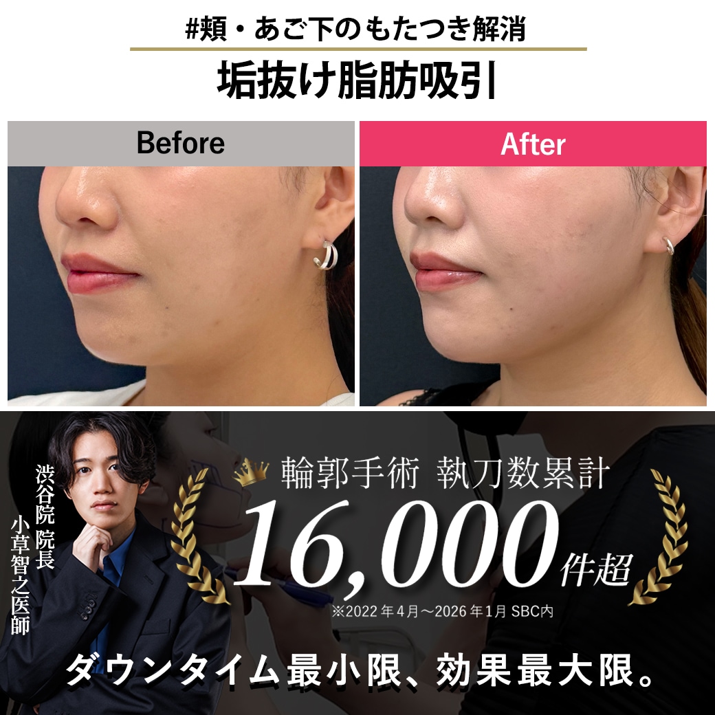 【顔の脂肪吸引の名医】メリハリある横顔に【脂肪吸引が上手いおぐさ先生】