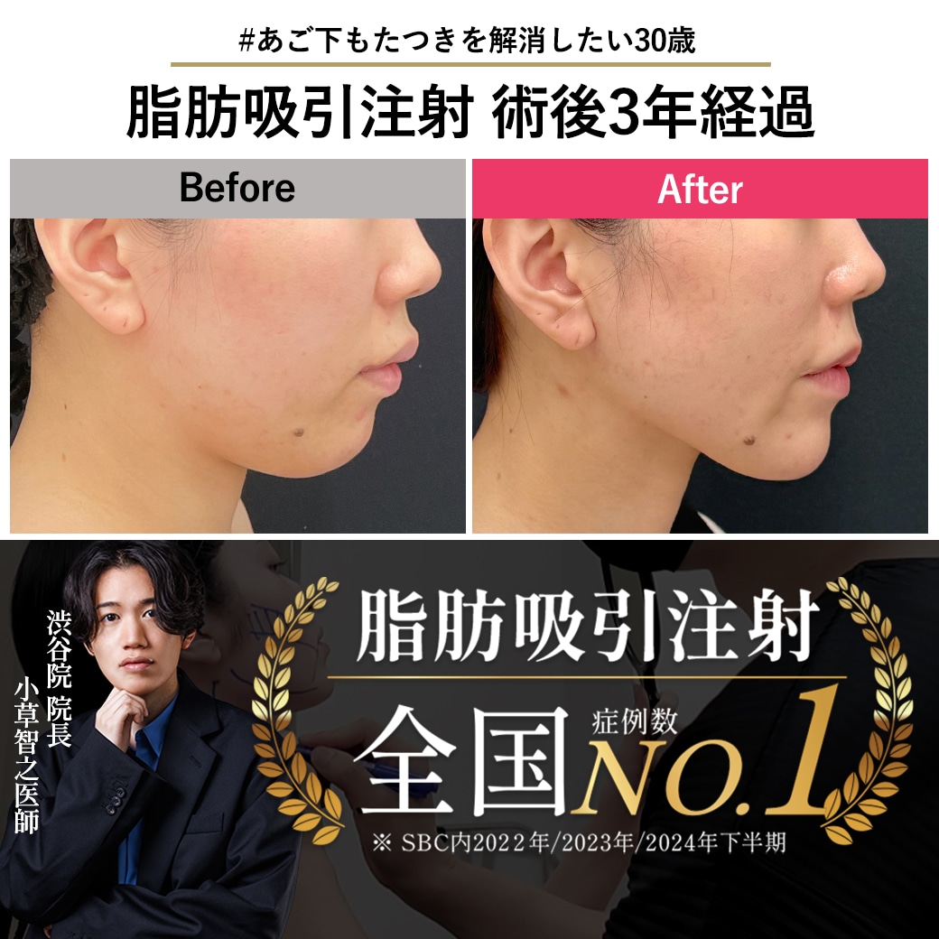 【脂肪吸引注射の名医】3年経っても後戻りなし！長期経過を紹介