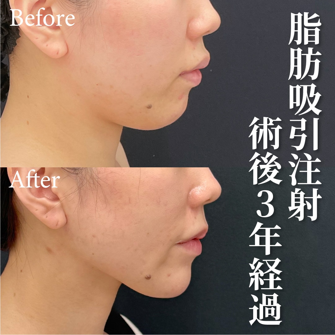 30代女性のモニター様
