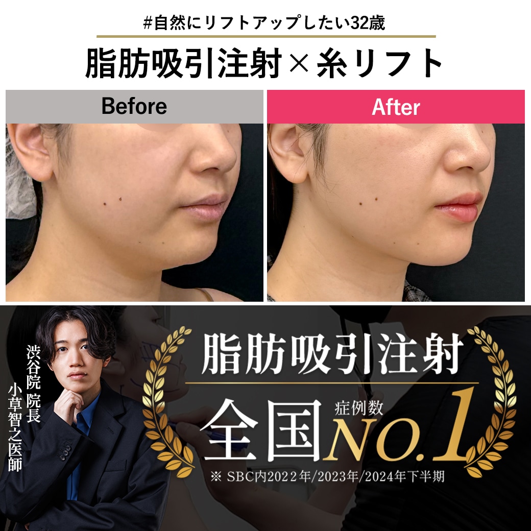 【脂肪吸引注射の名医】フェイスライン・口横もたつき解消