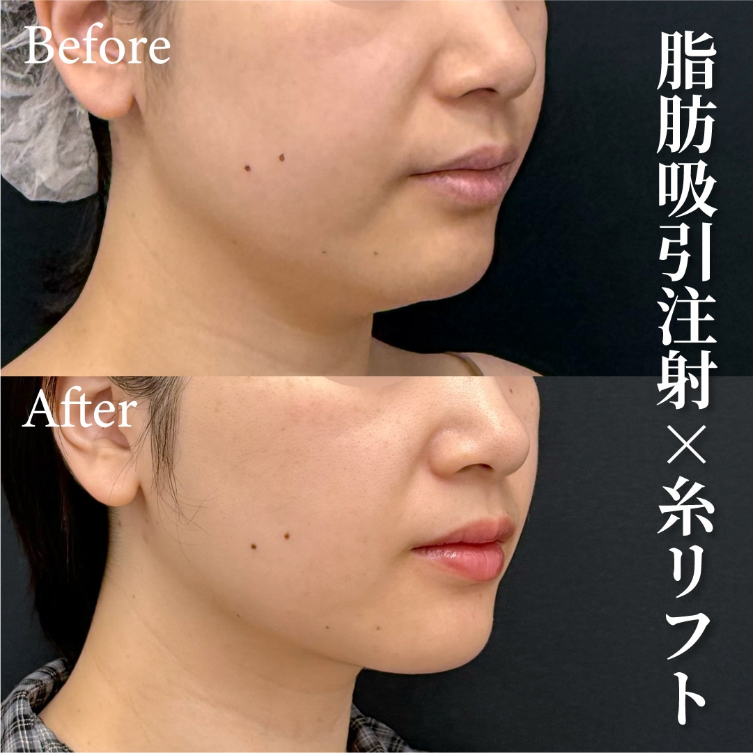 32歳女性のモニター様<br />

