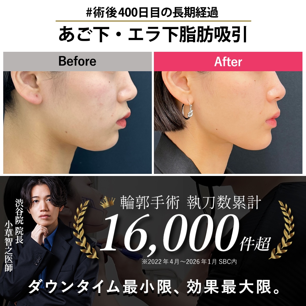【顔の脂肪吸引の名医】あご下脂肪吸引 術後400日目の経過【脂肪吸引が上手いおぐさ先生】