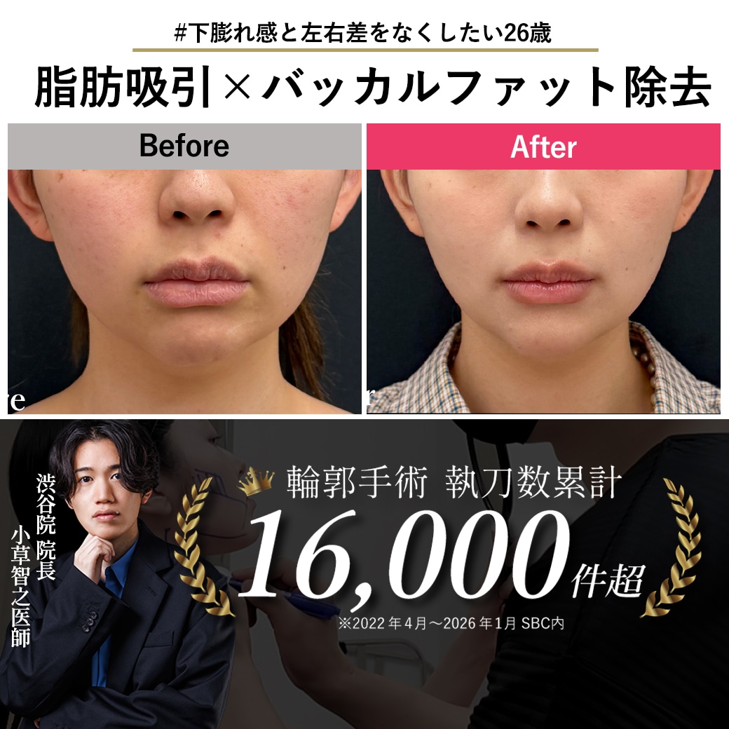 【下膨れ感・左右差をなくす】脂肪吸引×バッカルファット除去