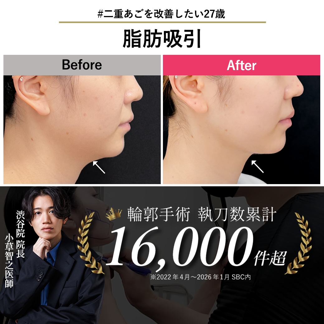 【顔脂肪吸引の名医】二重アゴを解消！埋もれていたフェイスラインを引き出し、写真が楽しくなる小顔術