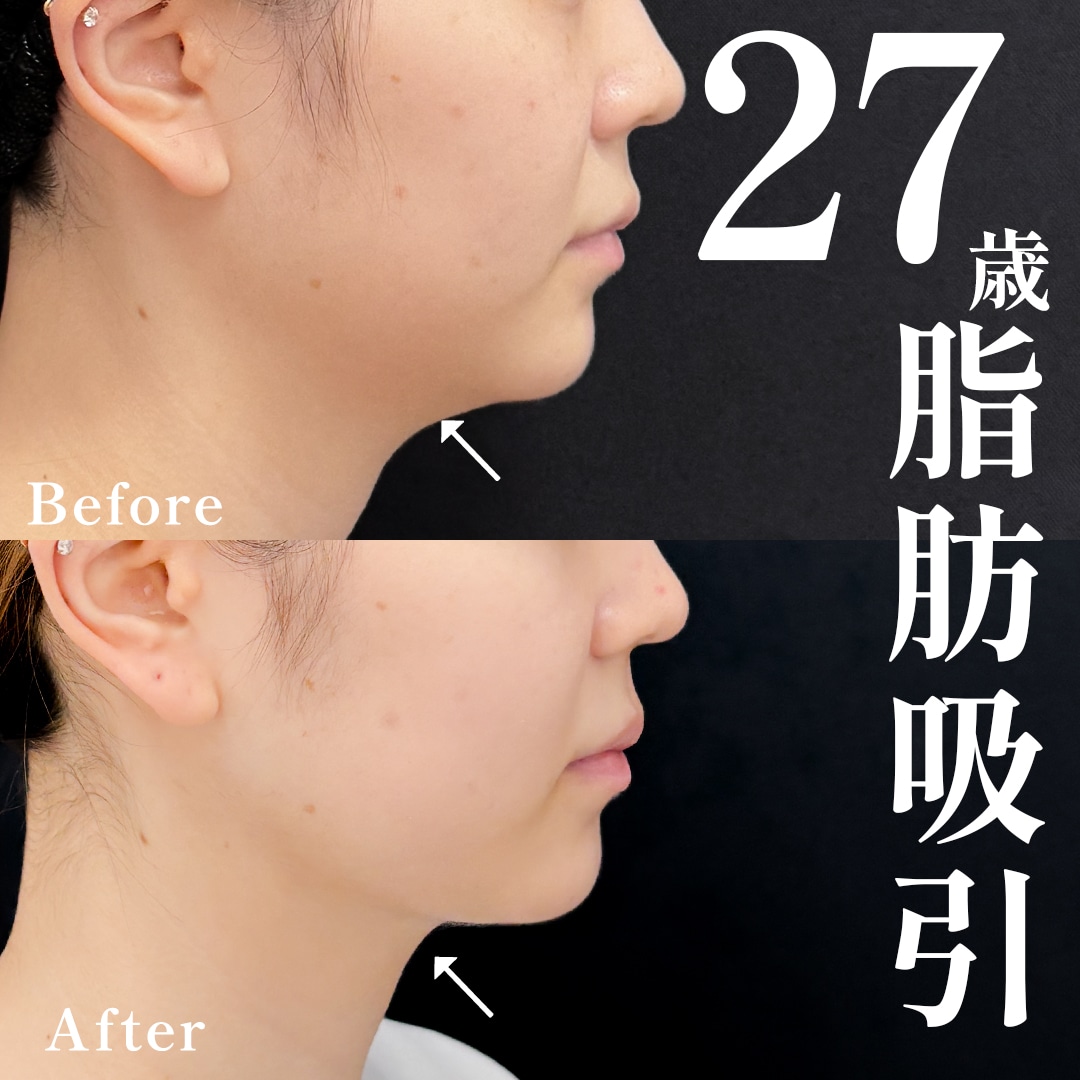 20代女性のモニター様
