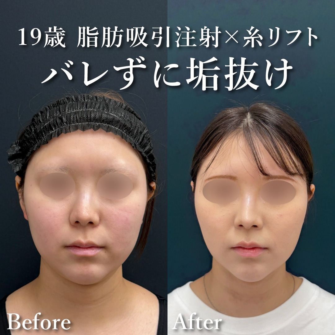19歳女性のモニター様<br />
