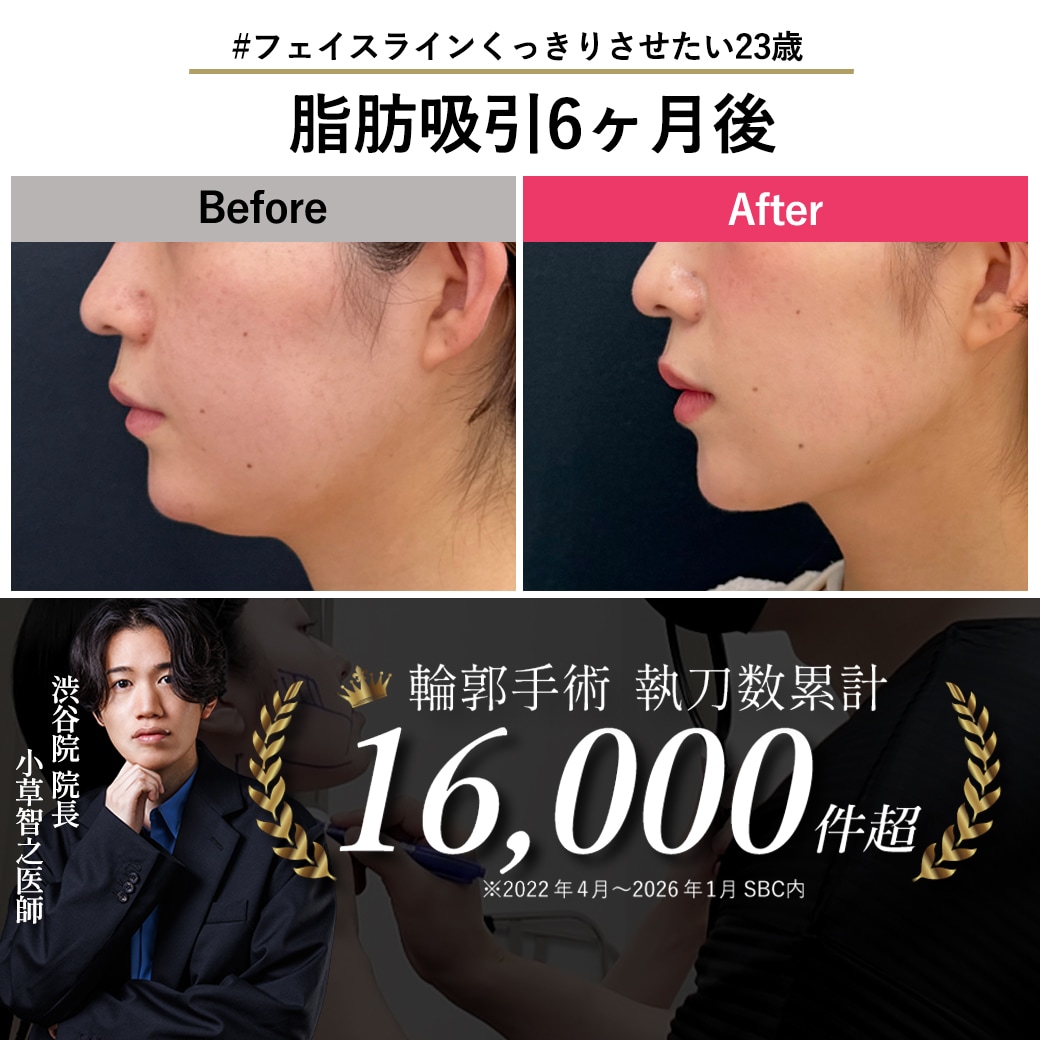 【顔の脂肪吸引の名医】23歳のアゴ下脂肪吸引×糸リフト【脂肪吸引が上手い小草先生】