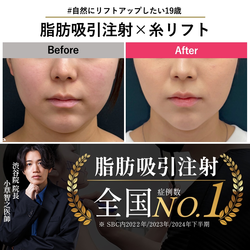 【脂肪吸引注射の名医】19歳の脂肪吸引注射
