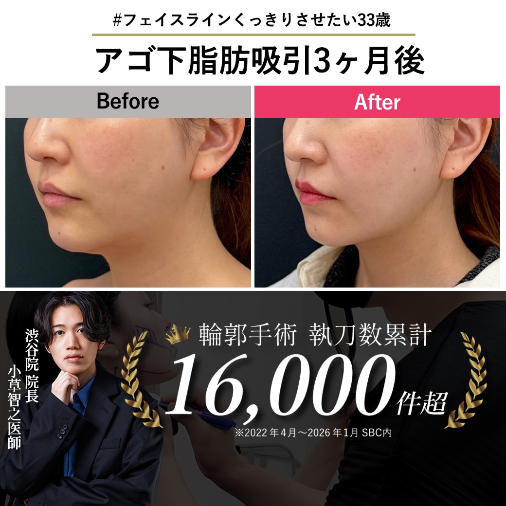 アラサーのもたつきをなくすアゴ下脂肪吸引