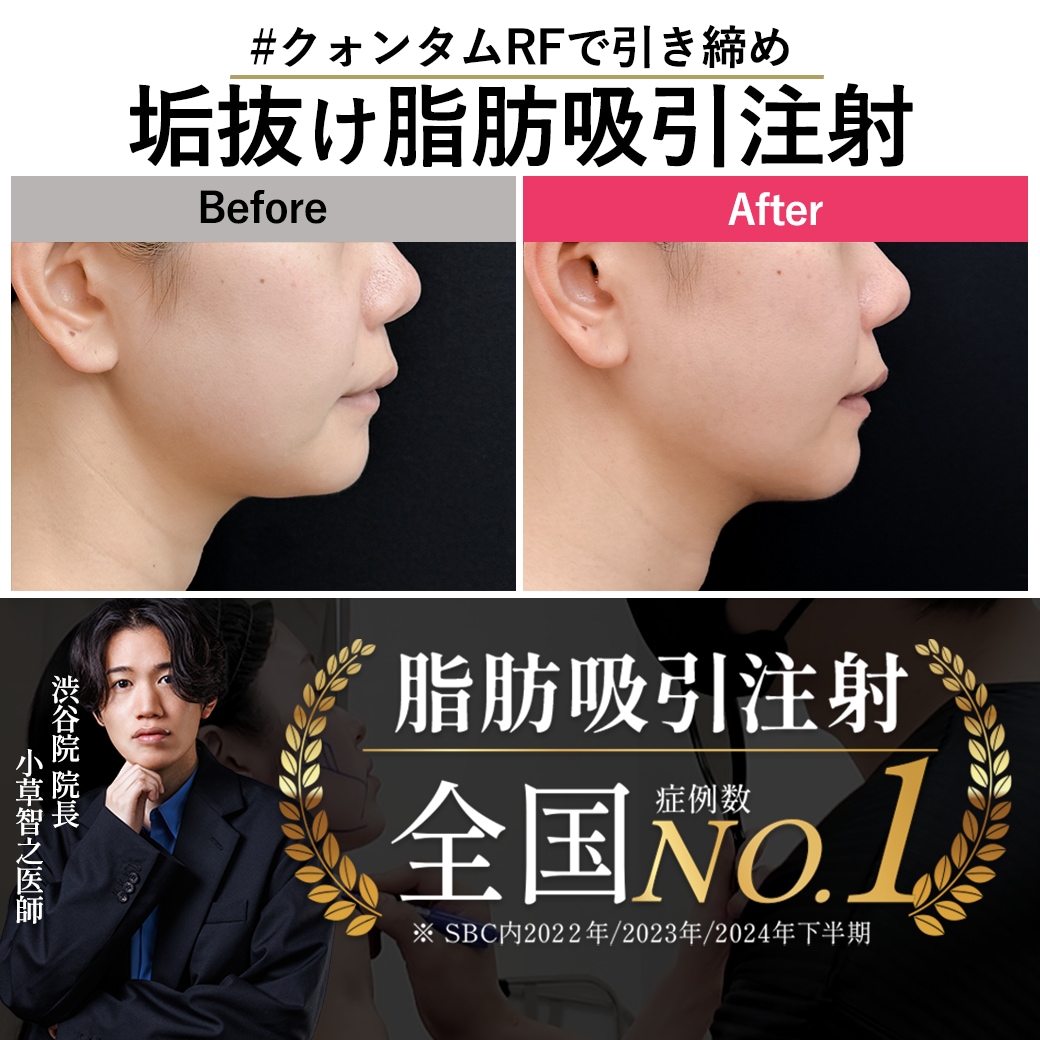 【顔の脂肪吸引注射の名医】脂肪吸引注射とクォンタムRF併用で叶える小顔術
