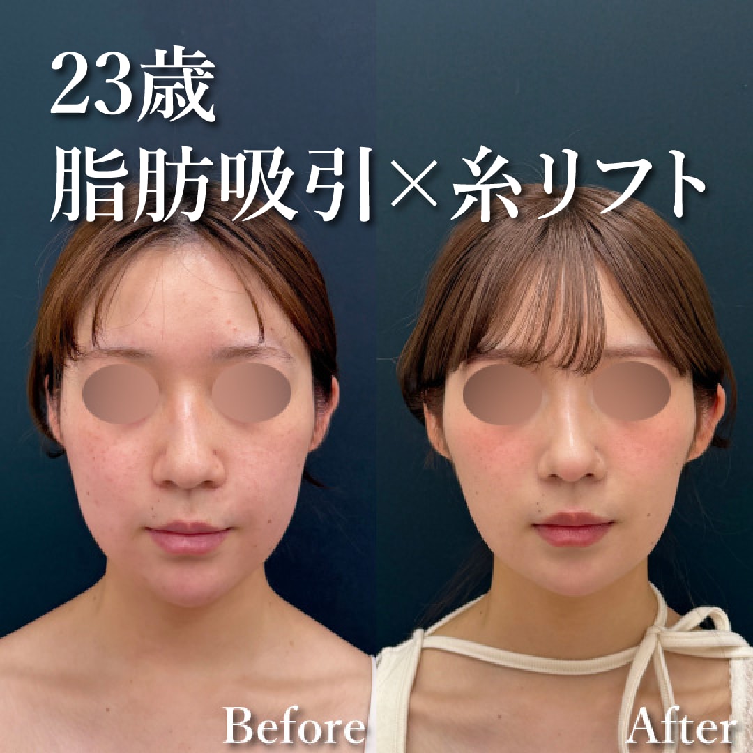 20代女性のモニター様