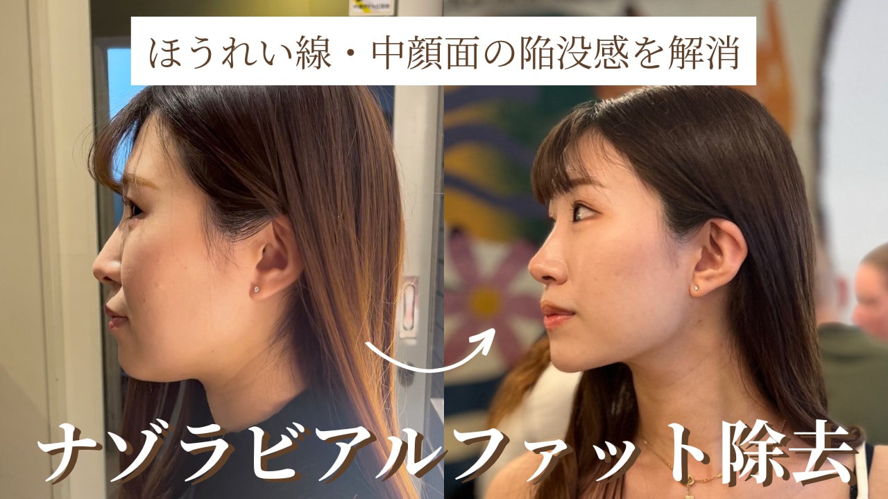 ナゾラビアルファット除去でほうれい線・中顔面の陥没感を解消！