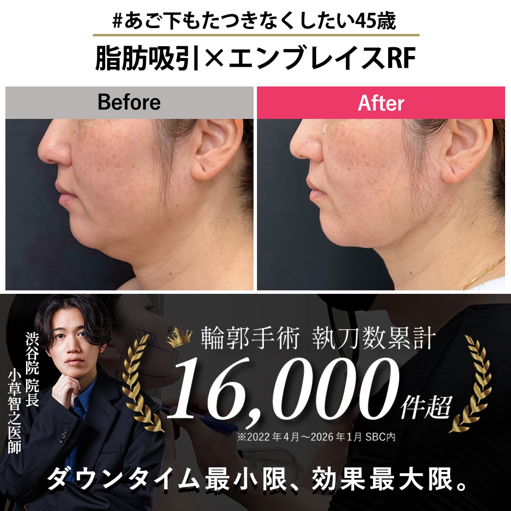 【顔の脂肪吸引の名医】45歳ミドル世代の輪郭たるみを解消【脂肪吸引が上手いおぐさ先生】