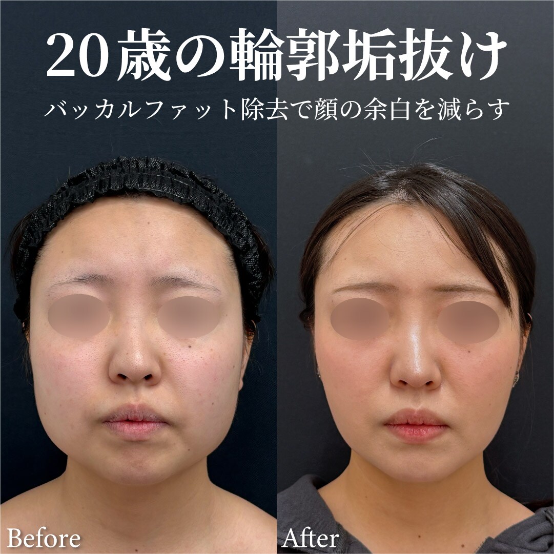 20歳女性のモニター様